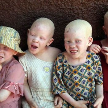 The-international-attention-in-favor-of-people-with-Albinism-in-Africa